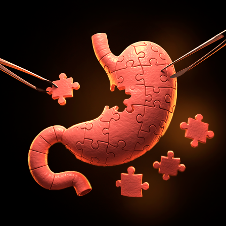 Redo bariatric surgeries